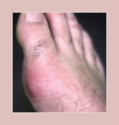 gout diet image healthtips images